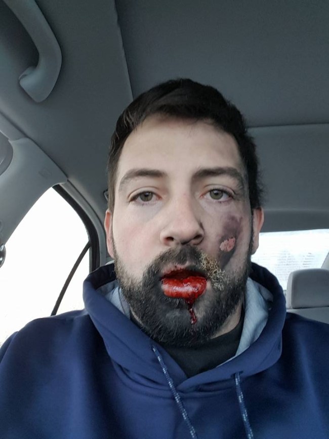 vape-explodes-in-mans-face-pics-1