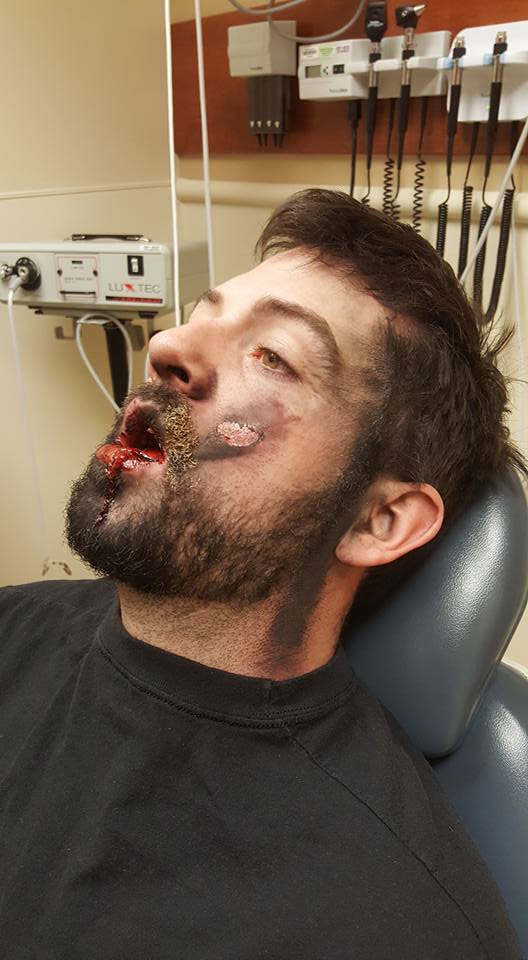 vape-explodes-in-mans-face-pics-2