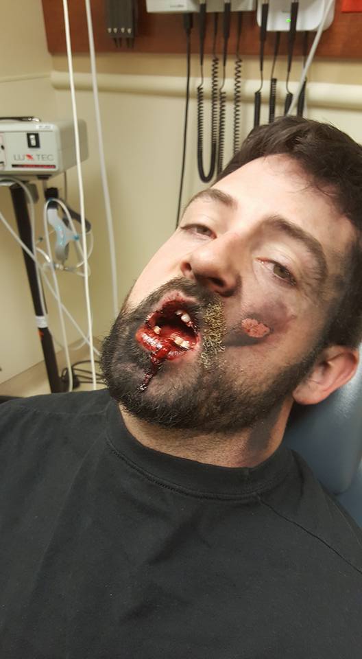 vape-explodes-in-mans-face-pics-3
