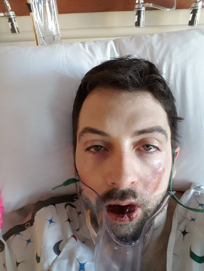 vape-explodes-in-mans-face-pics-4