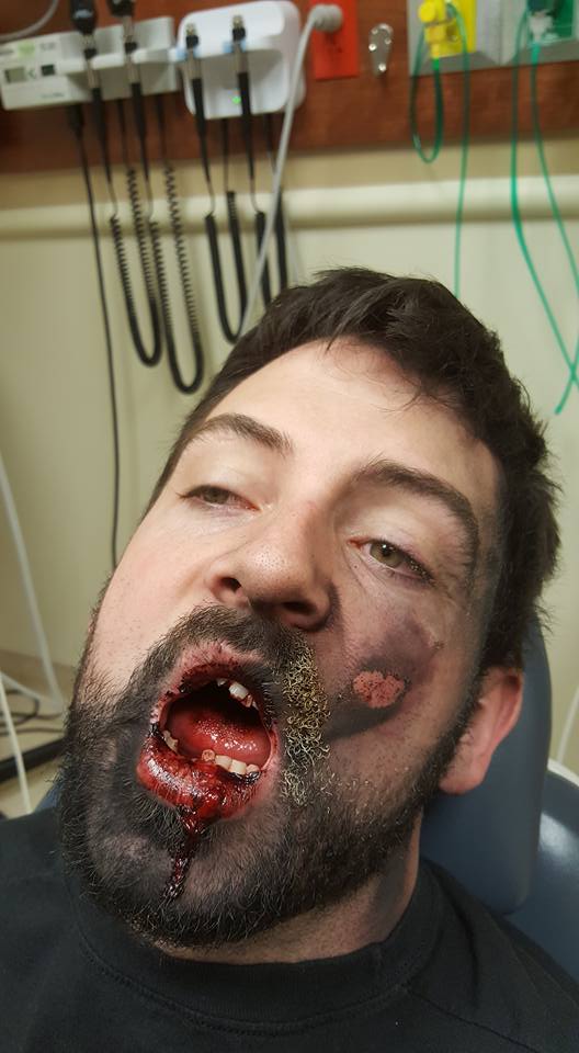 vape-explodes-in-mans-face-pics-6