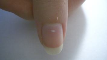 What The Frig Are Those White Marks On Your Fingernails? Can I Die From Them?