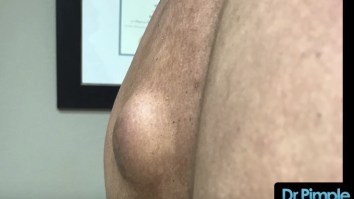 This Cyst Drain From Dr. Pimple Popper Is An Instant Hall Of Fame Candidate