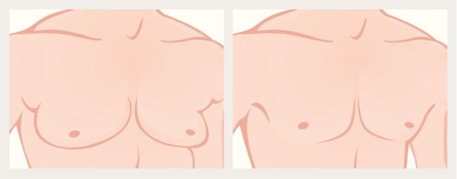 muscle implants chest