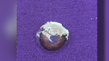 Woman Accidentally Glues Her Eye Shut After Mistaking Nail Glue For Eye Drops