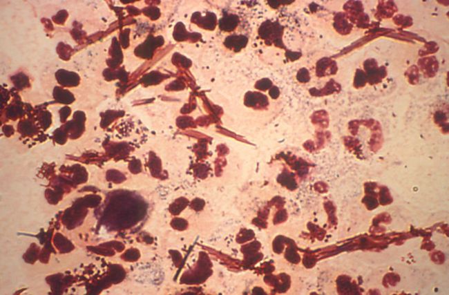 Austrian man contracted a strain of super gonorrhea after sex with a sex worker in Cambodia without wearing a condom.