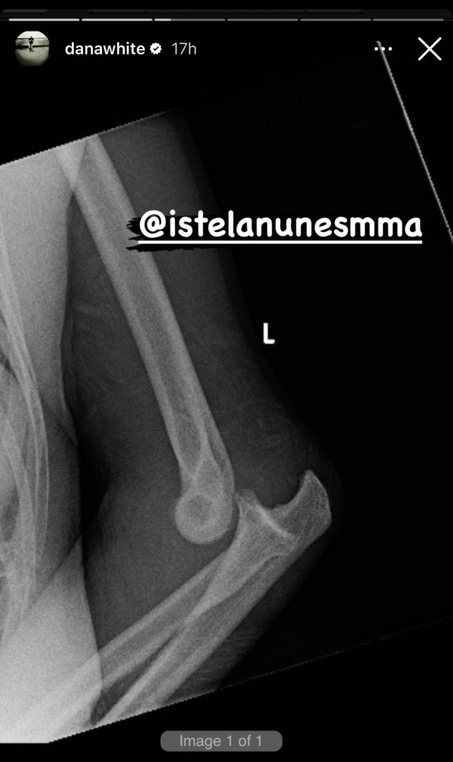 Istela Nunes X-Ray 1