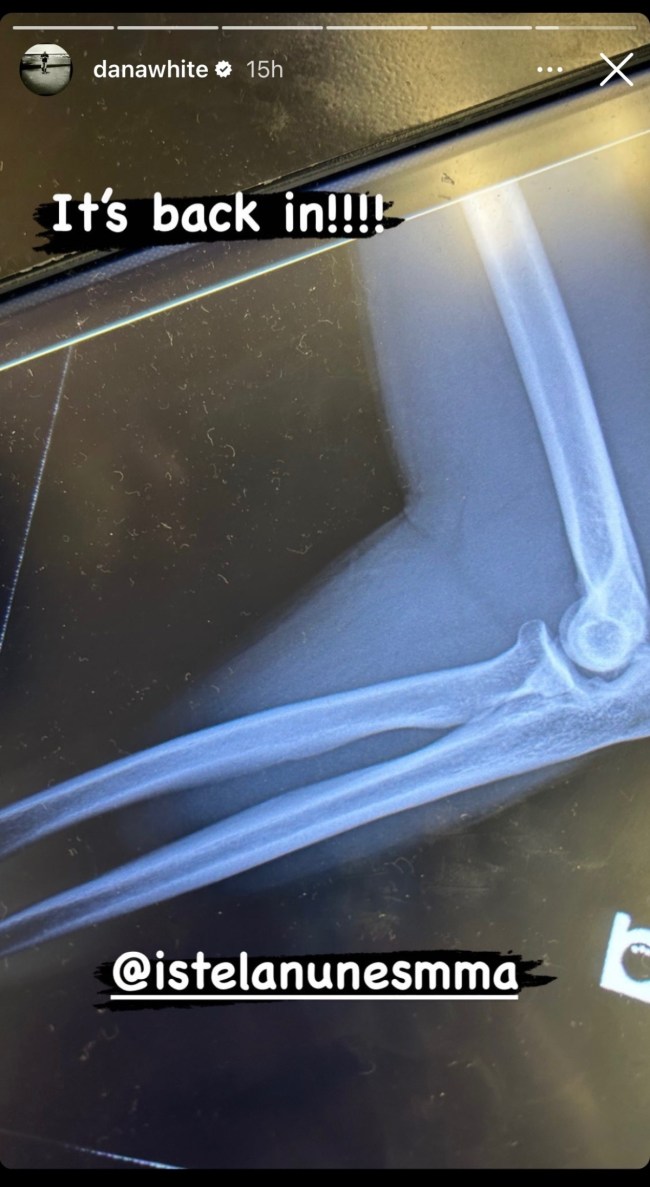 Istela Nunes X-Ray 2