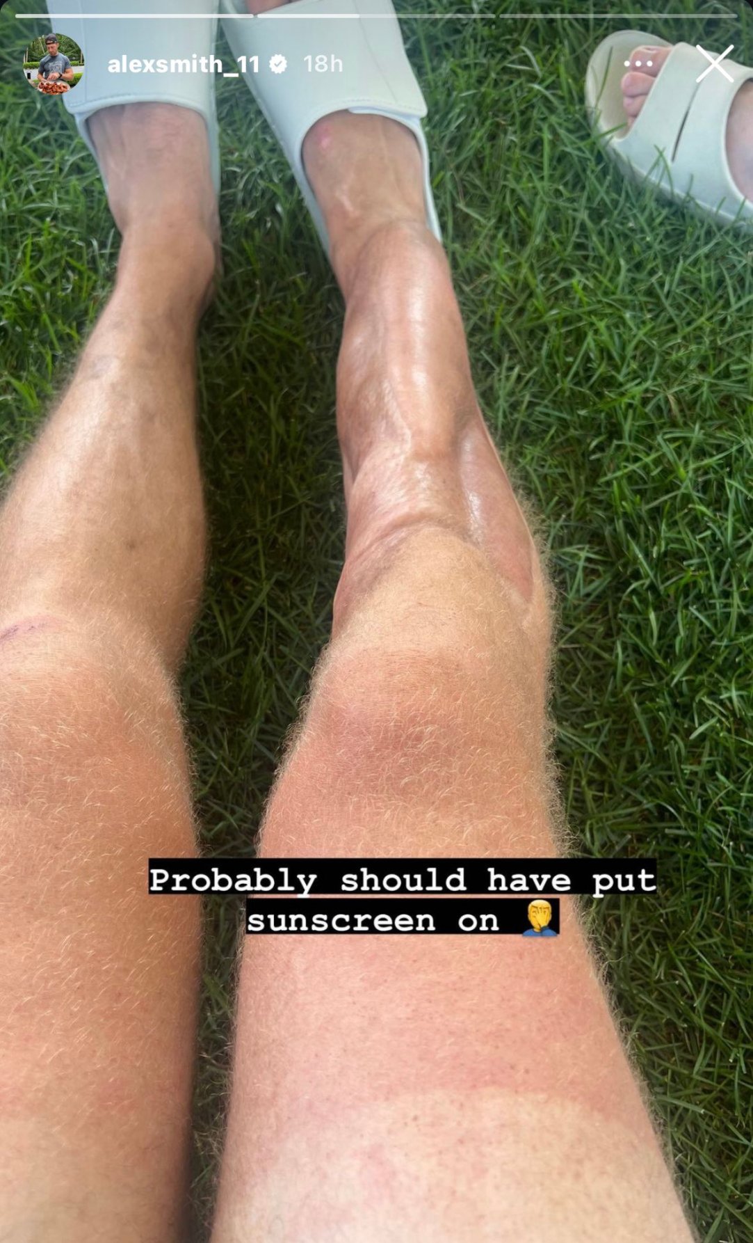 Alex Smith Leg Injury